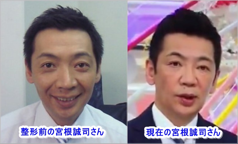 宮根誠司の整形疑惑と顔の激変！眼瞼下垂手術の真相と現在を追う