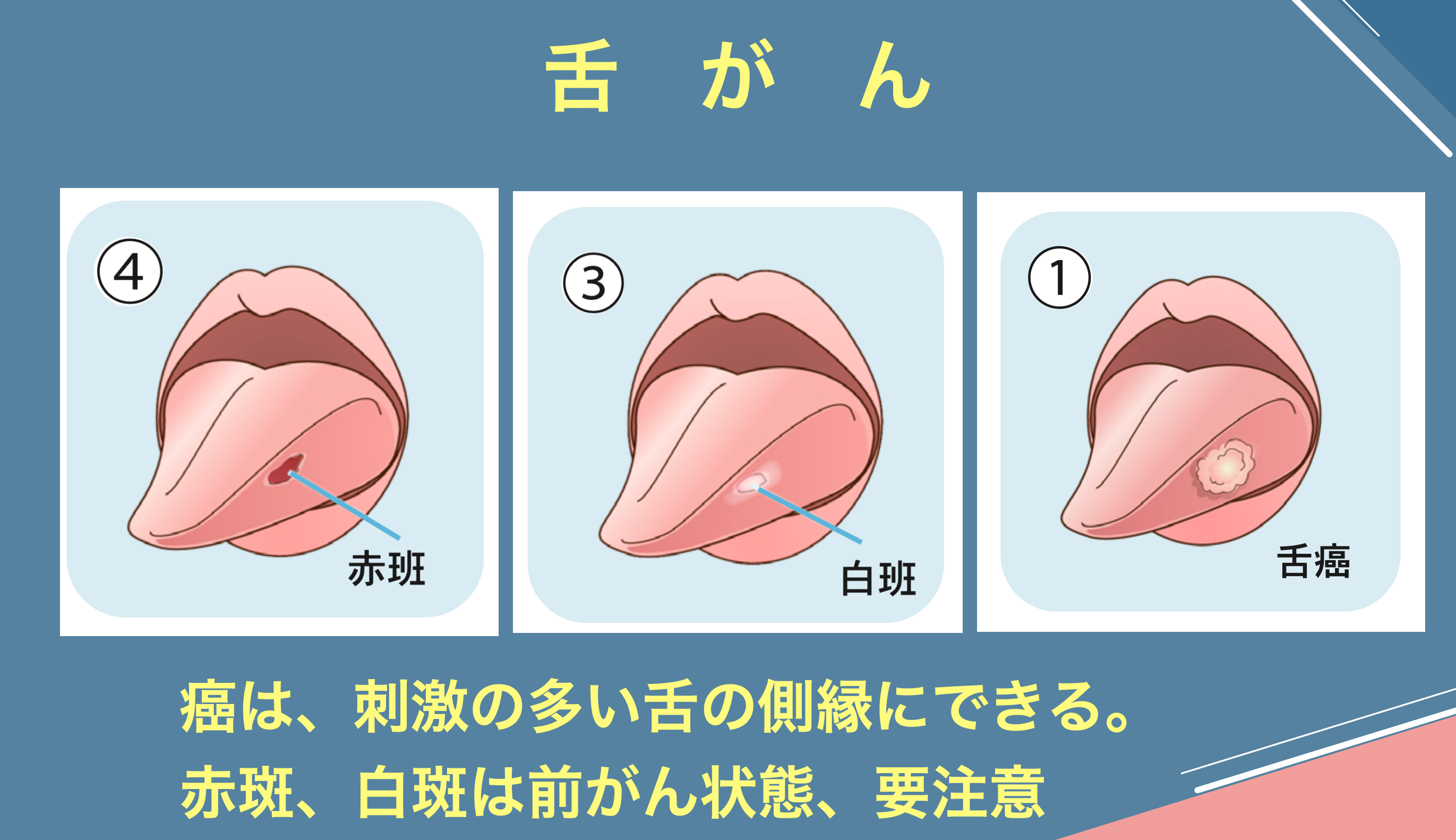 舌の側面が痛い原因は？口内炎と舌がんの見分け方や受診科を徹底解説