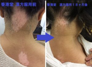 「ありのままの肌」で輝く時代へ――2026年、尋常性白斑を公表した芸能人たちが変えた「美の基準」と社会の視線