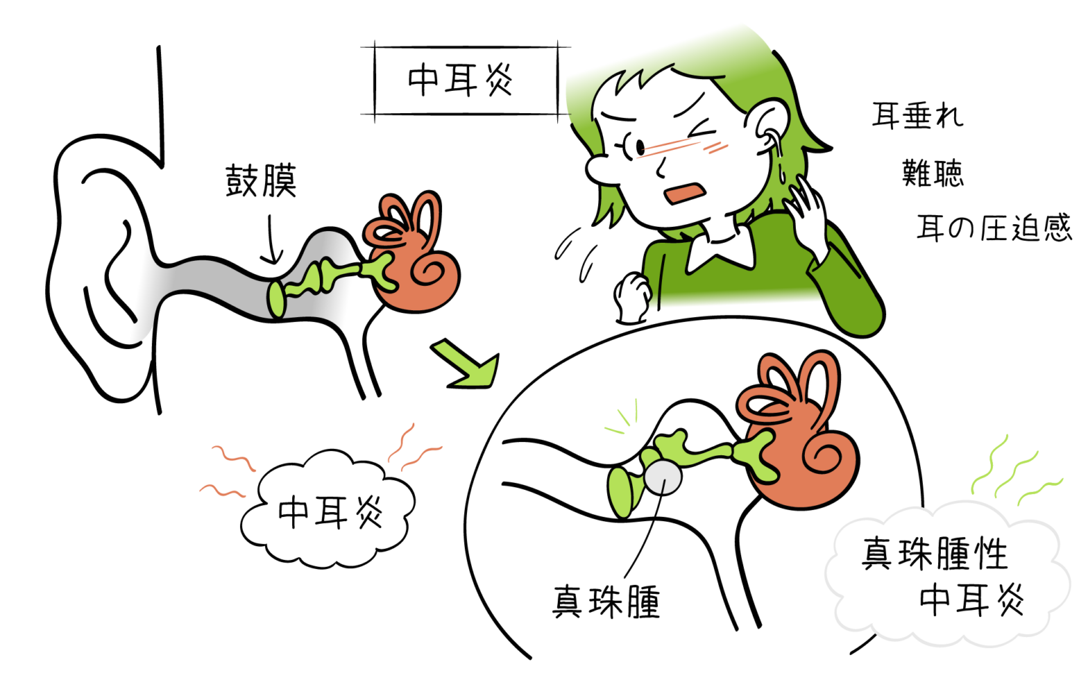 耳を澄ませば聞こえる悲鳴。なぜ「突発性難聴」はエンタメ界を襲い続けるのか？2026年の警鐘
