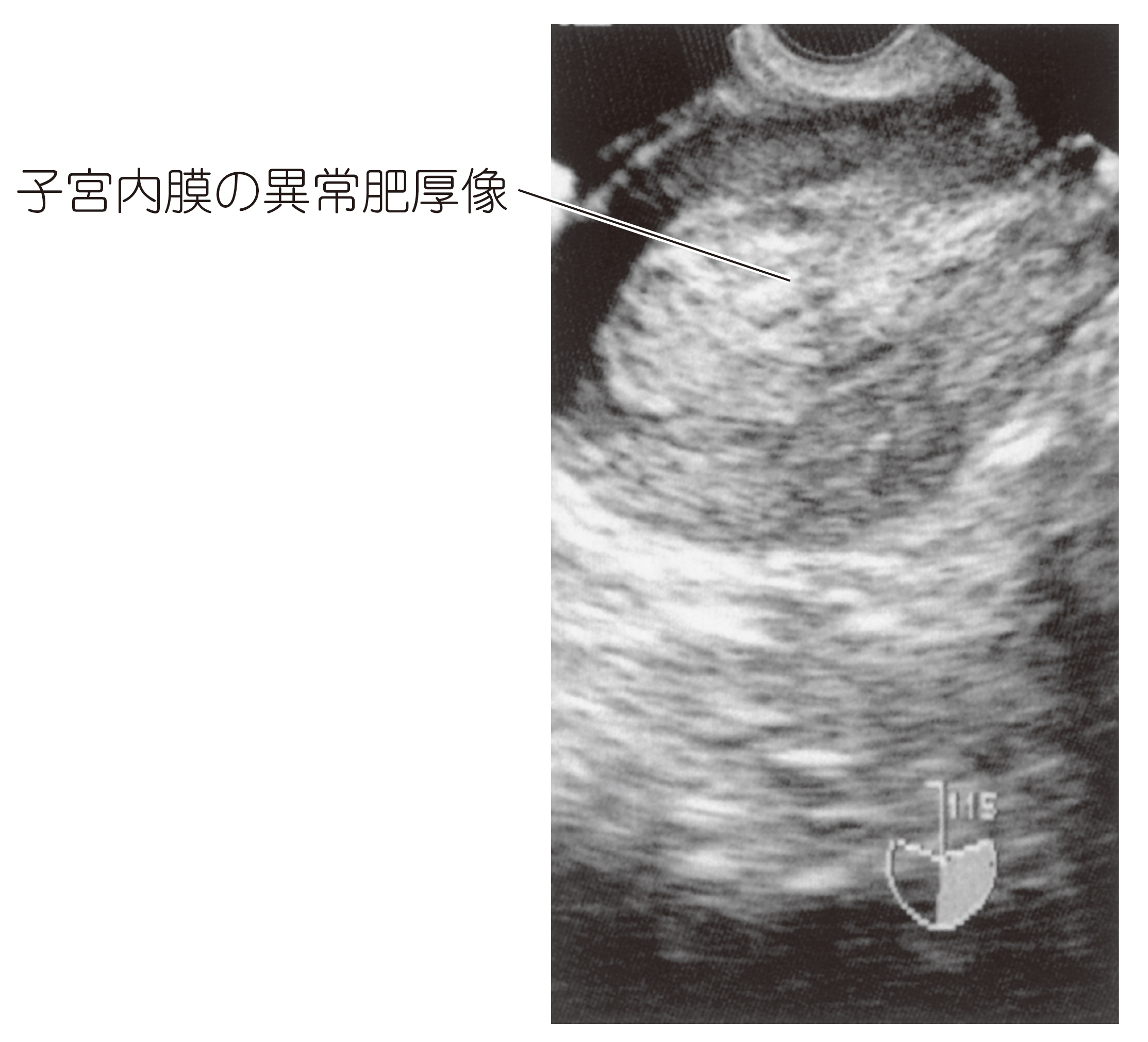 子宮体癌エコー画像で何がわかる？内膜肥厚の基準値と見逃しリスク