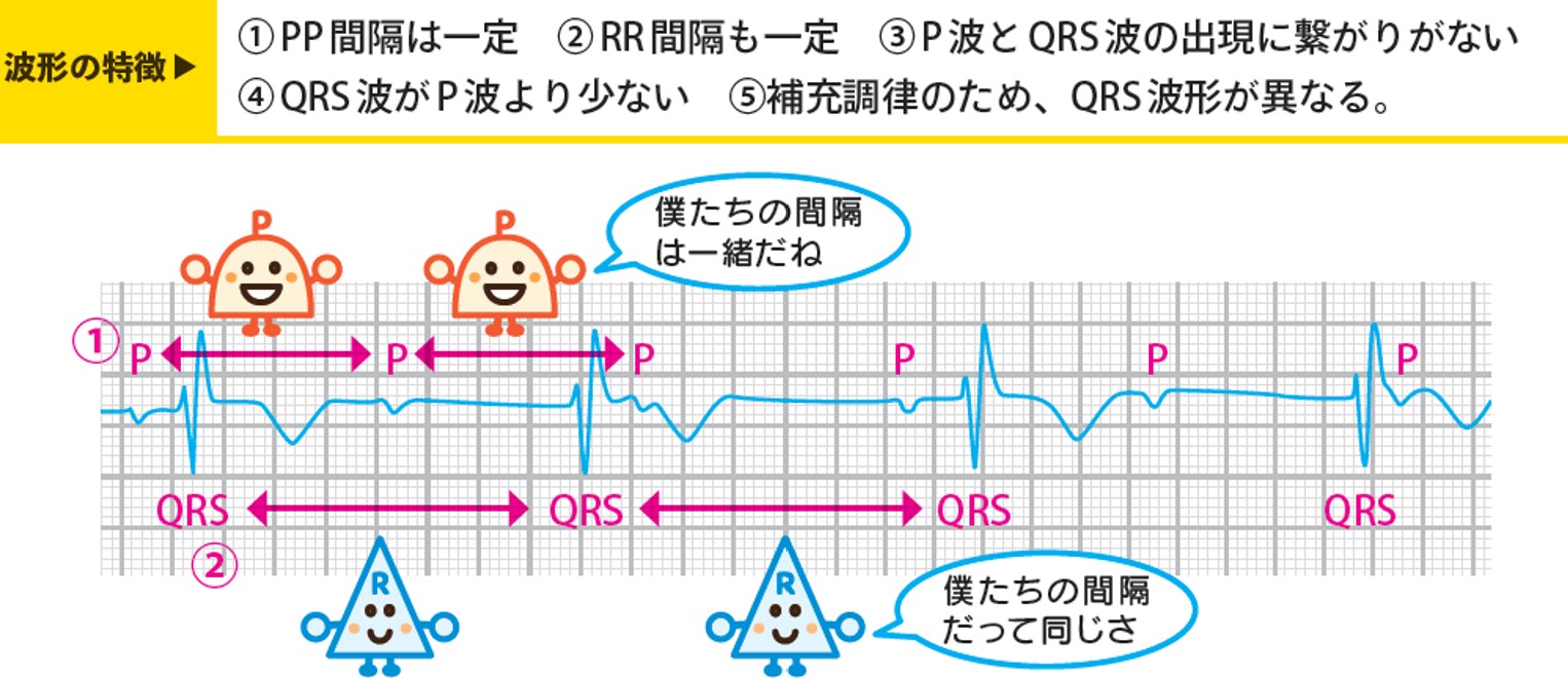 完全房室ブロックの兆候と真実｜突然死を防ぐペースメーカー治療基準