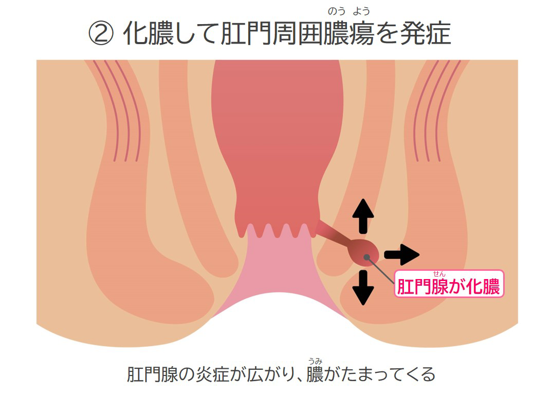 お尻の穴が痛い原因と治し方｜切れ痔・いぼ痔から危険な病気まで解説