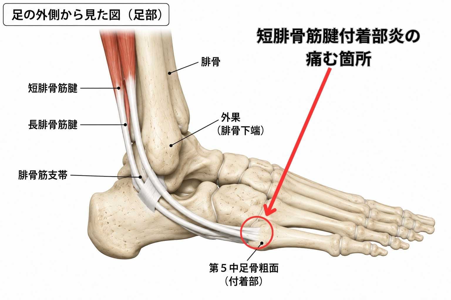 足の外側の激痛！短腓骨筋腱付着部炎の治し方と骨折見分け方【2026】