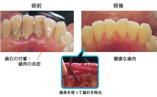 歯垢を爪で取るのは絶対Ng？歯茎の破壊と細菌感染の恐るべき真実
