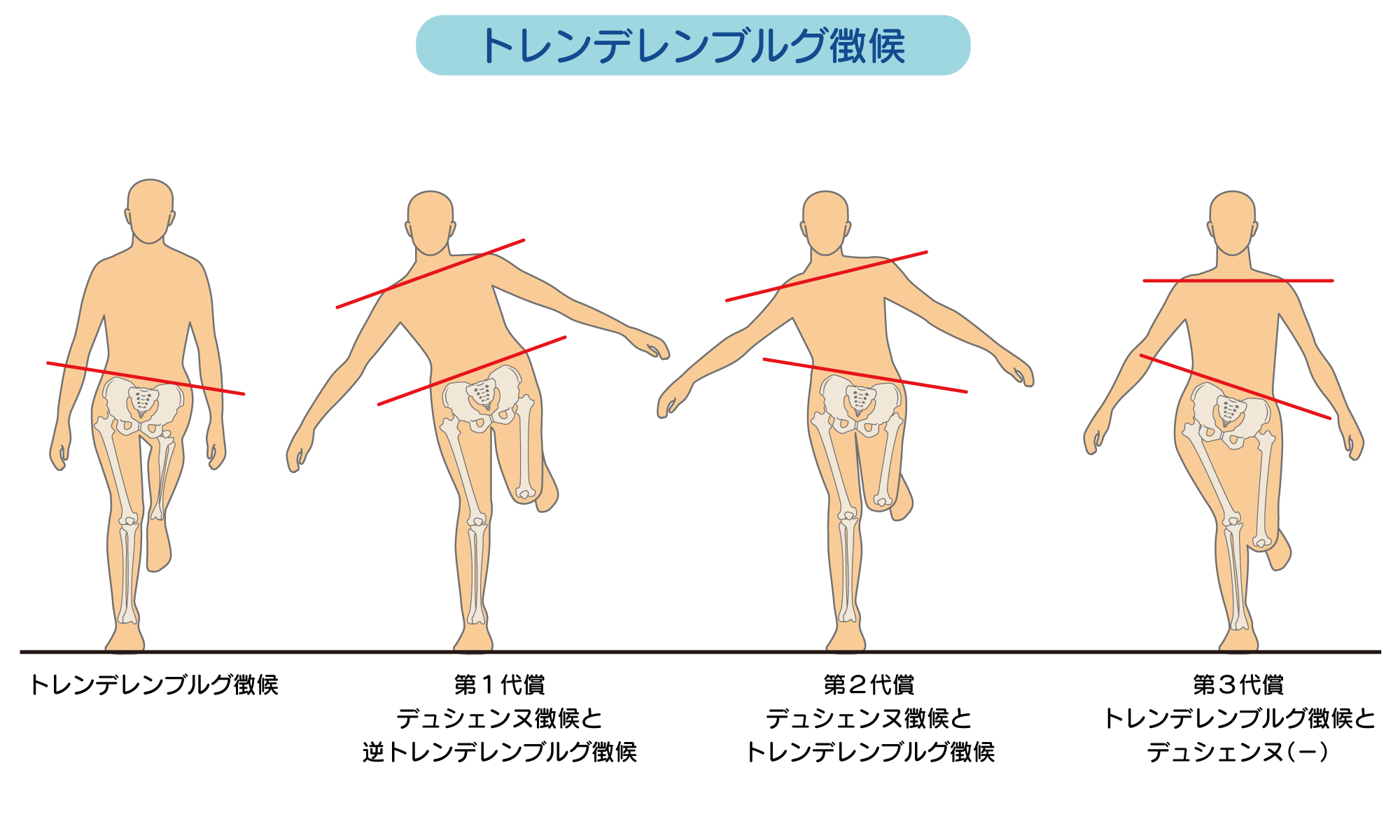 トレンデレンブルグ徴候と歩行の真実｜デュシェンヌとの違いと臨床評価