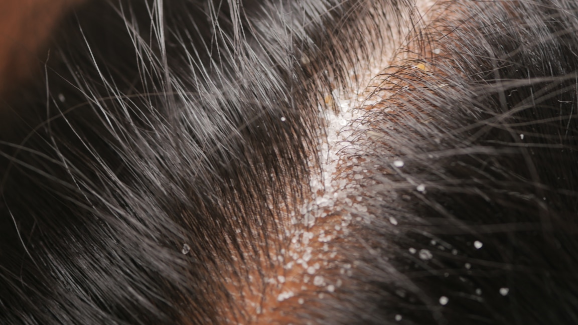 Why Is My Scalp So Flaky and Dry