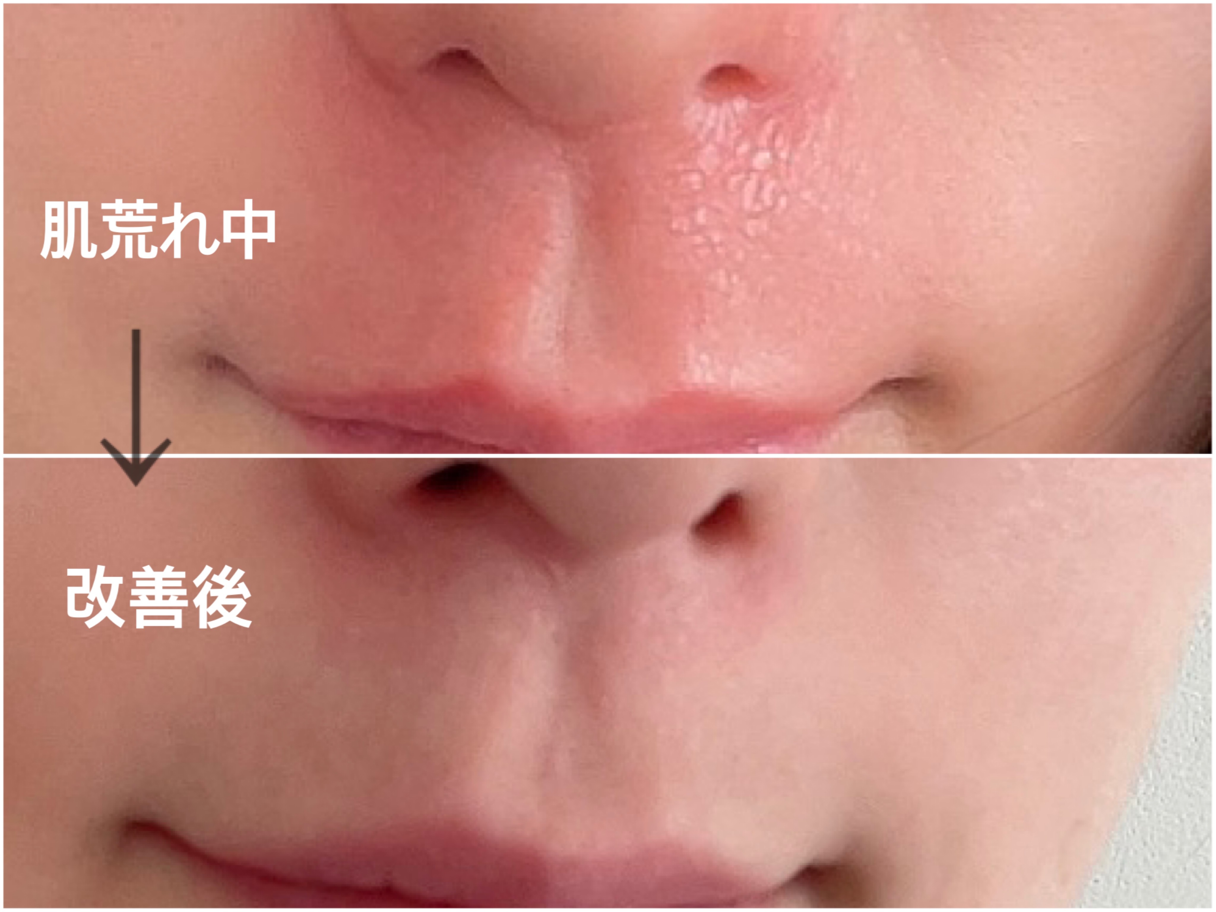 鼻のかみすぎで痛い！赤み・ヒリヒリを即効で治す方法と新常識