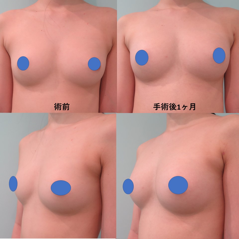 レッドカーペットを席巻する「横乳」の美学と表現規制の最前線