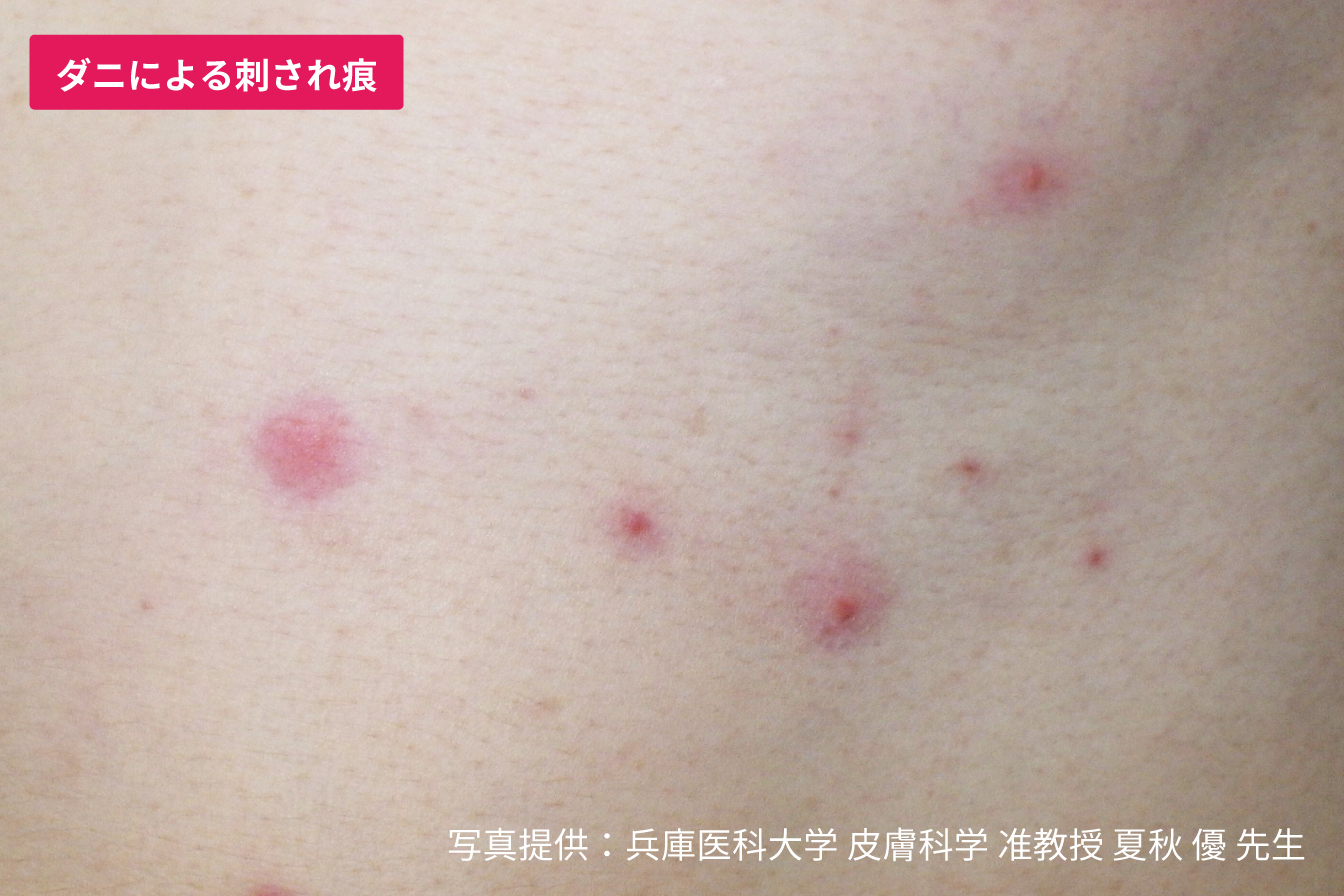 足のかゆみはダニの仕業？虫刺されの見分け方と夜間の猛烈なかゆみ撃退術