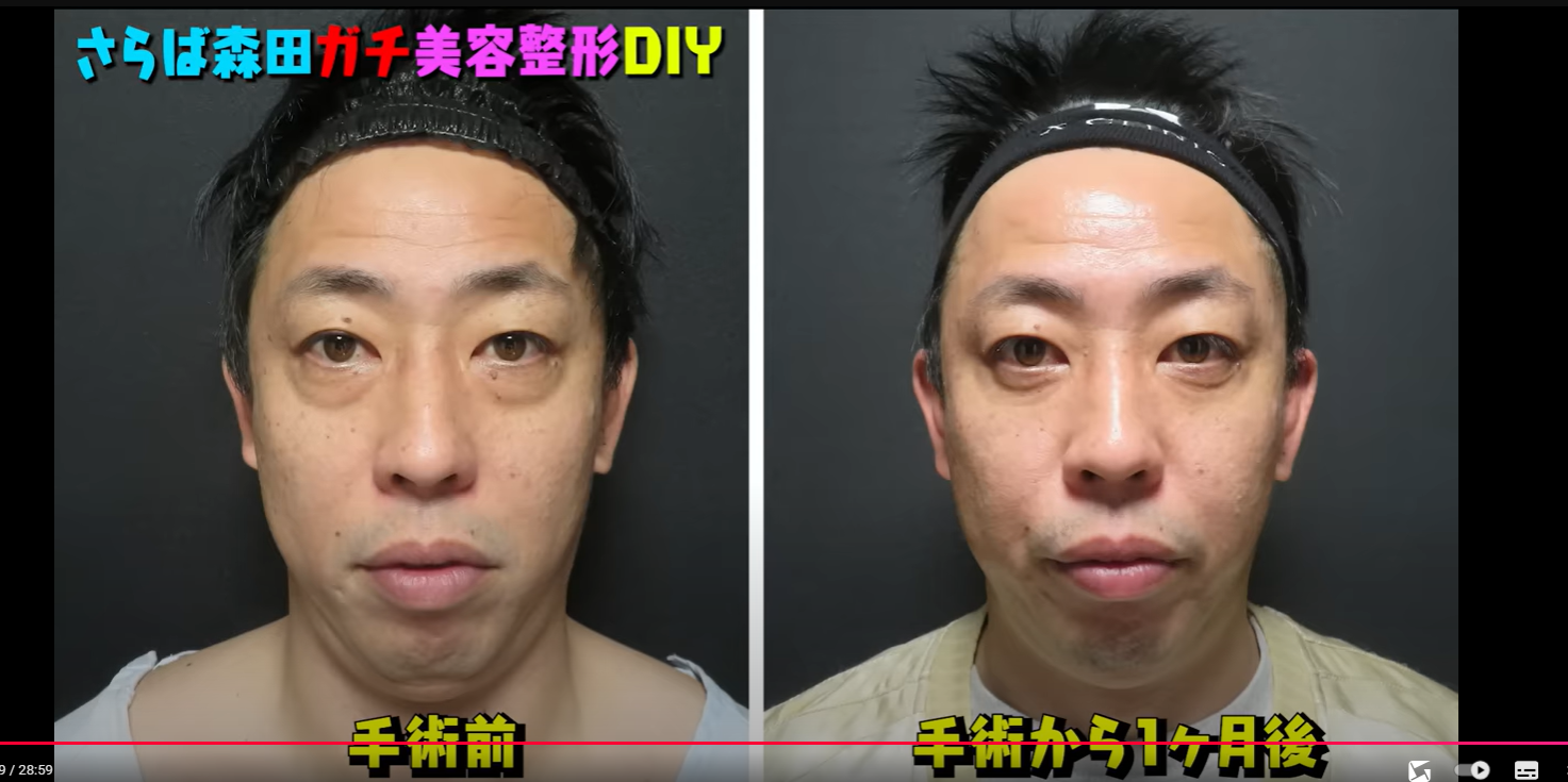 目の下のたるみ整形で劇的若返り？芸能人の公表・噂の真相と術式の罠