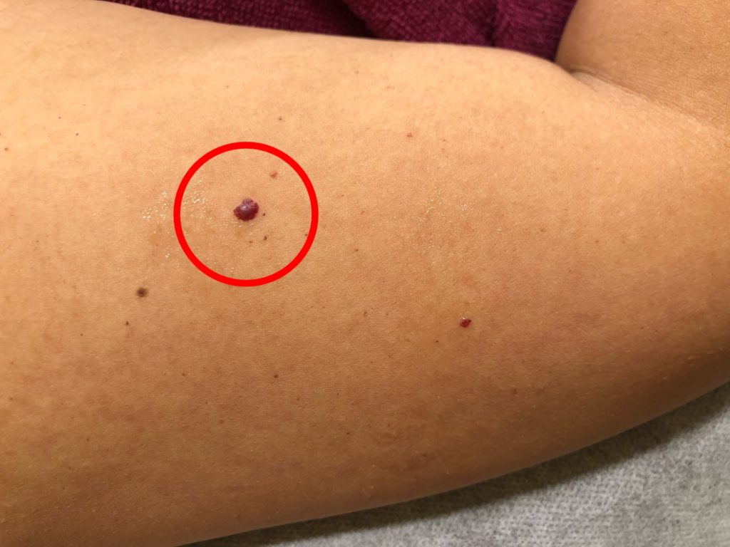 腕の小さい赤い点やかゆくない斑点の正体は？原因と受診目安を徹底解説