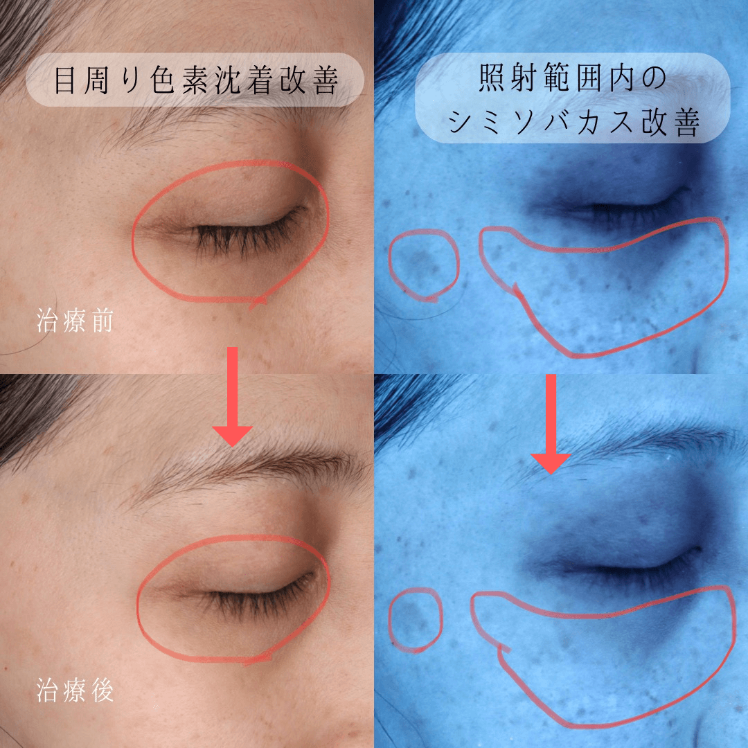 目の周りの色素沈着を消す方法｜茶クマの真因と皮膚科医が教える改善策