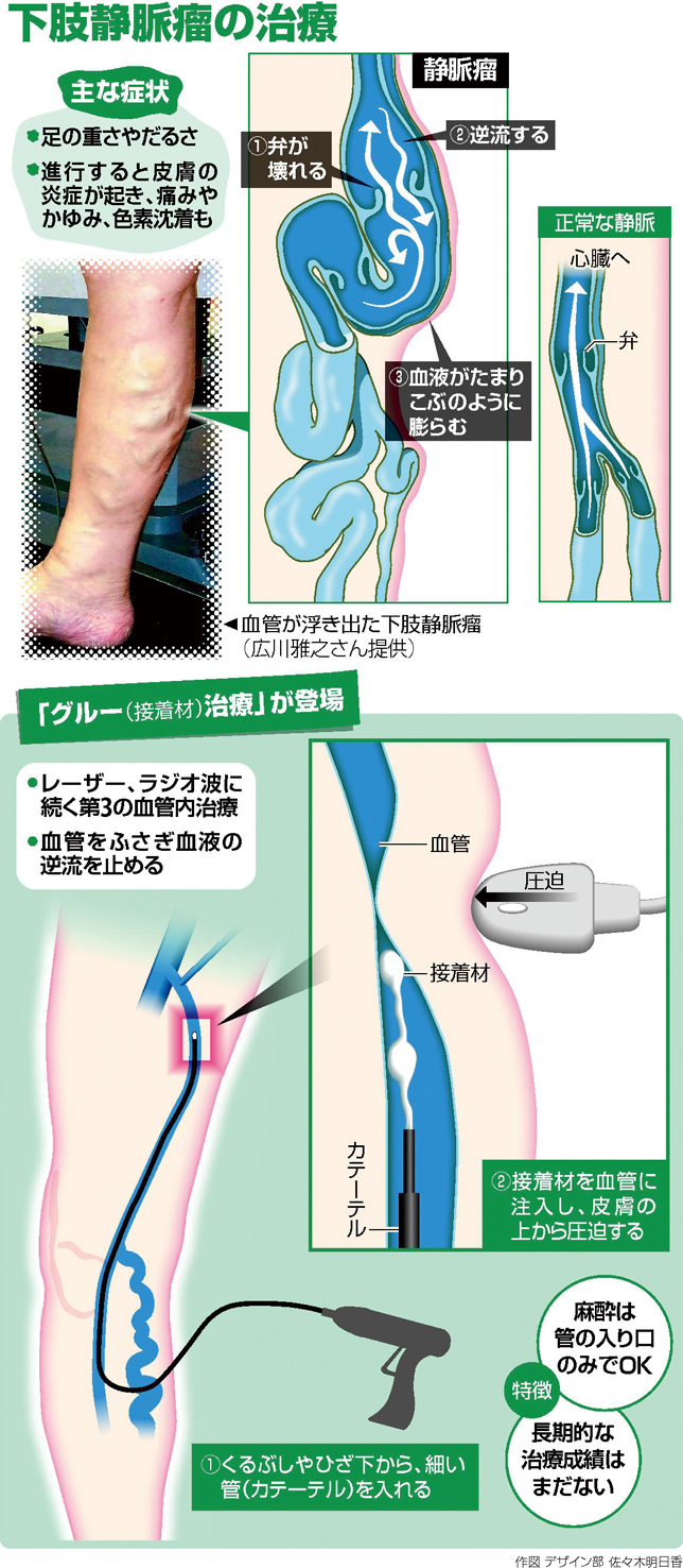 下肢静脈瘤治療、保険適用の日帰り手術で費用はいくら？2026年最新版