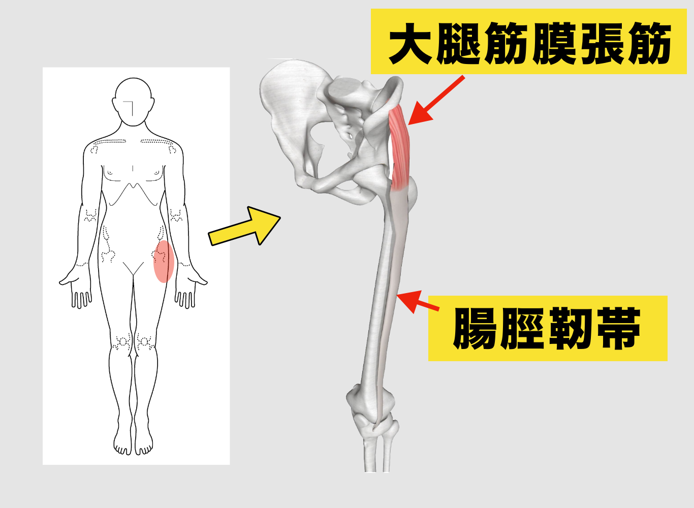 太ももの張りや股関節痛の元凶？大腿筋膜張筋の正しいほぐし方と原因解剖
