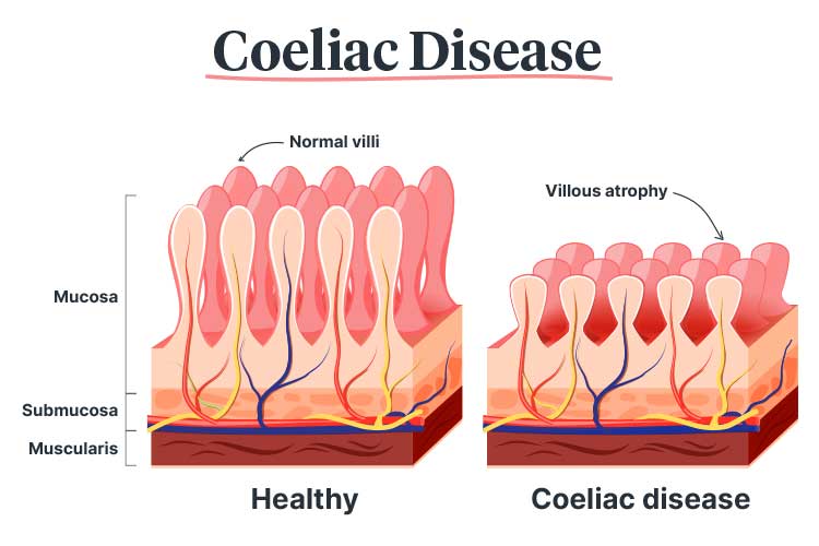 Do I Have Coeliac Disease