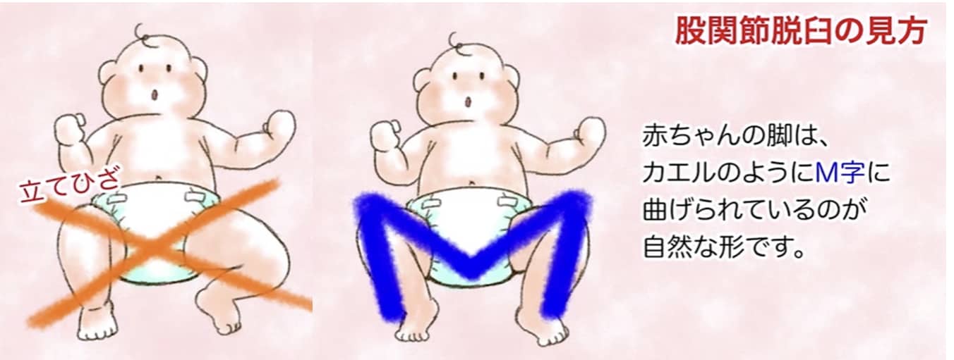 赤ちゃんの片足が動かない？股関節脱臼を疑う足の動きと早期チェック