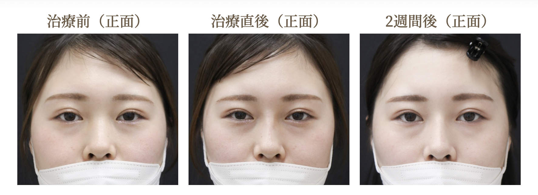 鼻筋とはどこの位置？通っている人の特徴と整える方法を徹底解説
