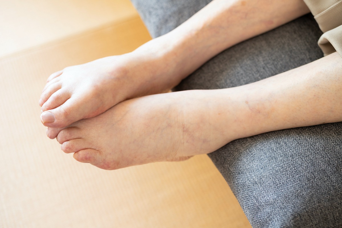 足のむくみは腎臓病のSos？疲労との違いと受診目安を徹底解説