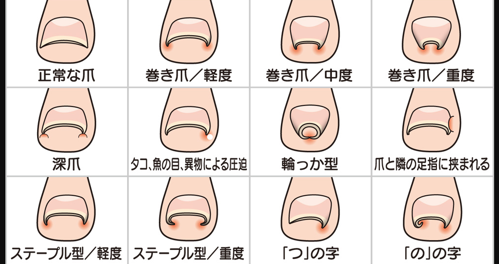 【真相】 爪 に 現れる 病気 の サイン 最新情報まとめ 2026 #987