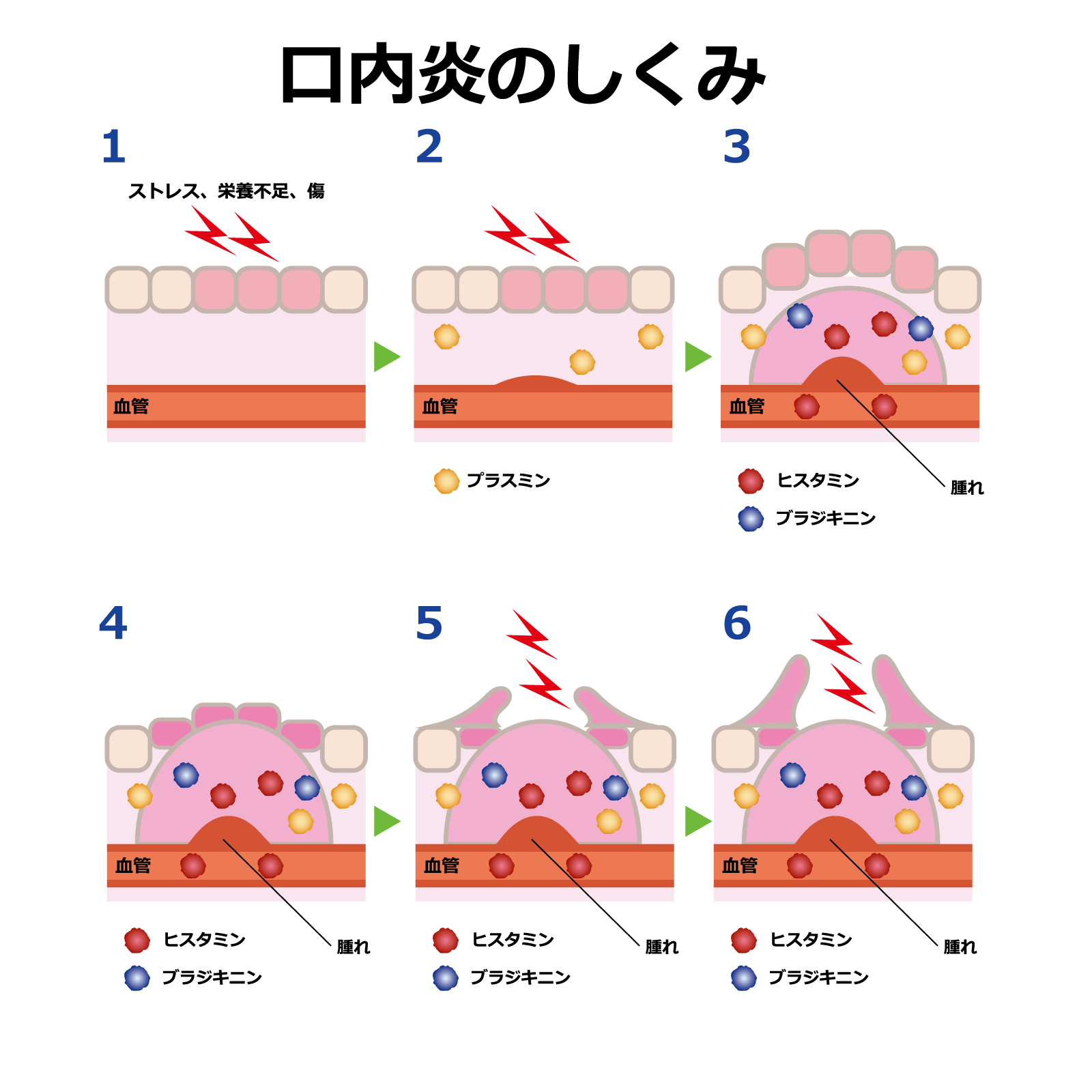 【2026年最新】激痛の口内炎を劇的に早く治す「裏ワザ」検証！即効ケアと医学的に正しい治し方