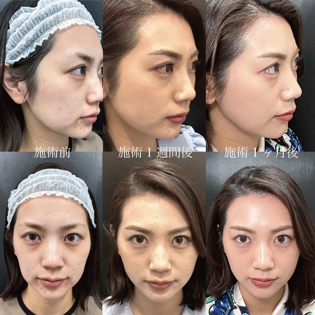 糸リフトの効果と持続期間を徹底解剖｜失敗防ぐ本数と2026年最新相場