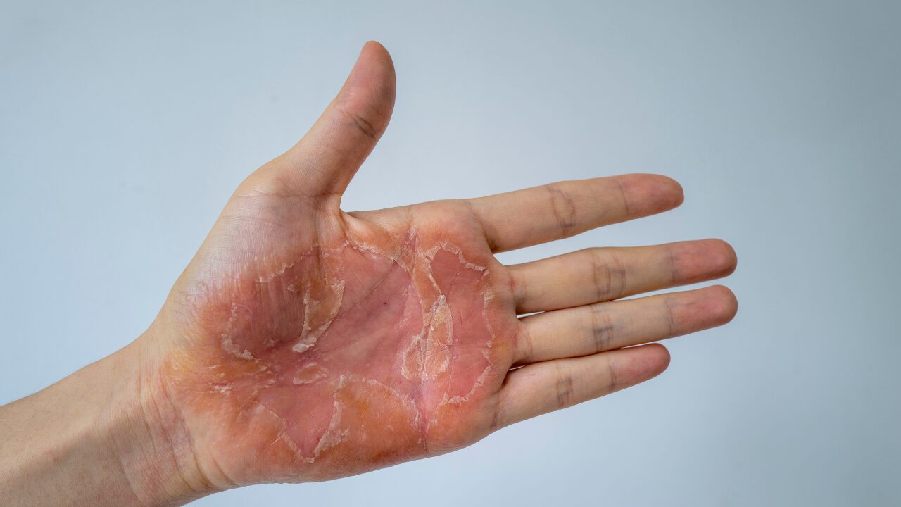 手のひらの皮がむける原因と病気一覧｜かゆくない理由と正しい治し方