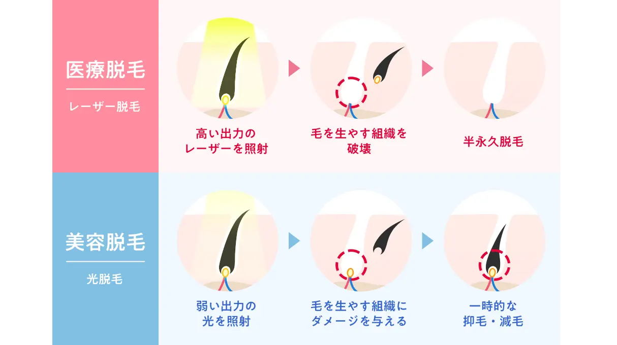 医療脱毛と美容脱毛の違いを比較！後悔しない効果・料金・痛みの真相