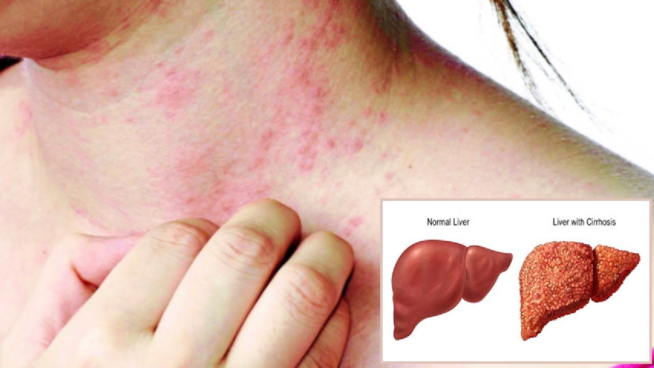 Does Liver Damage Cause Itchy Skin