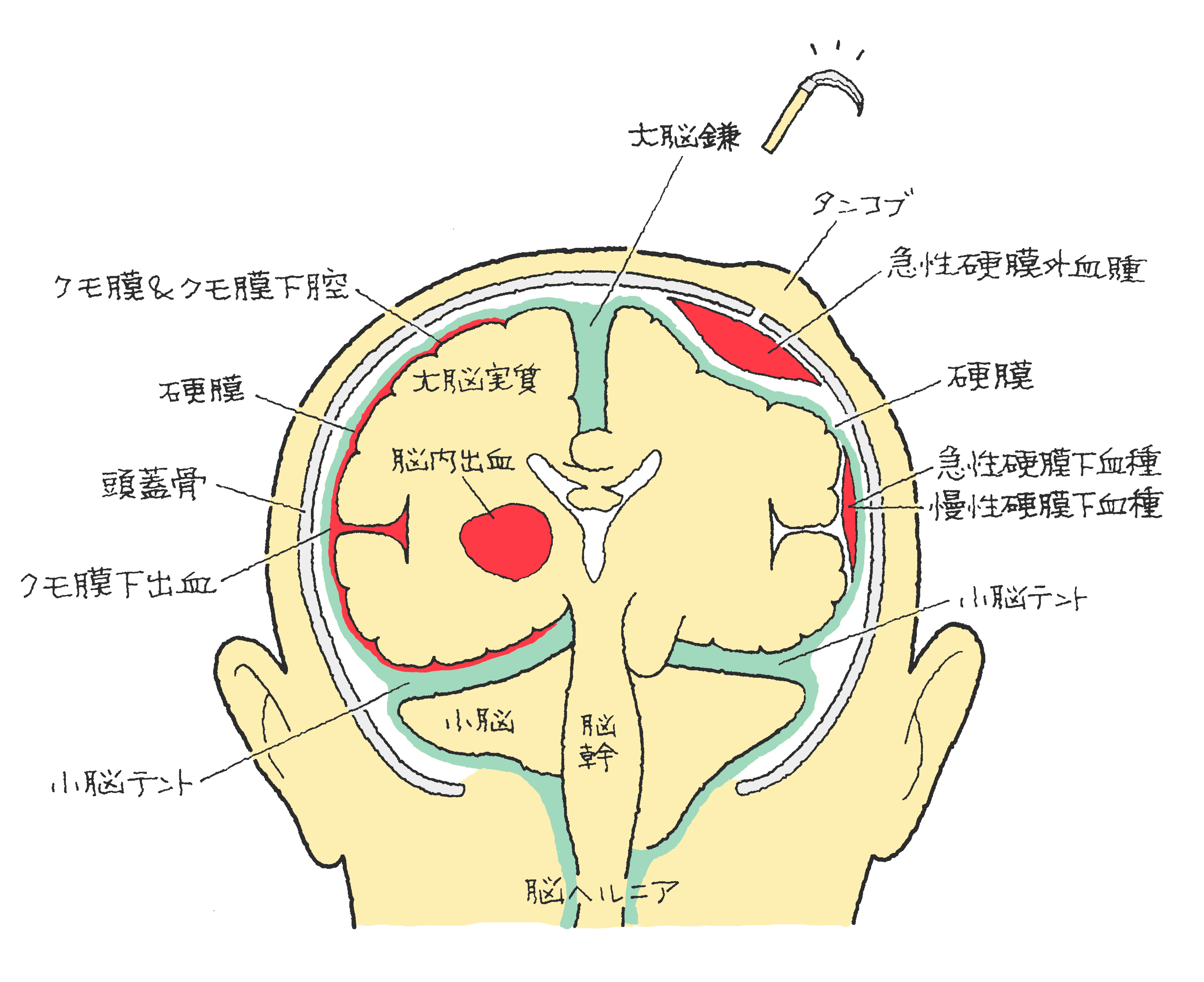 外傷性くも膜下出血の生存率と後遺症｜軽症が急変する真実と入院期間