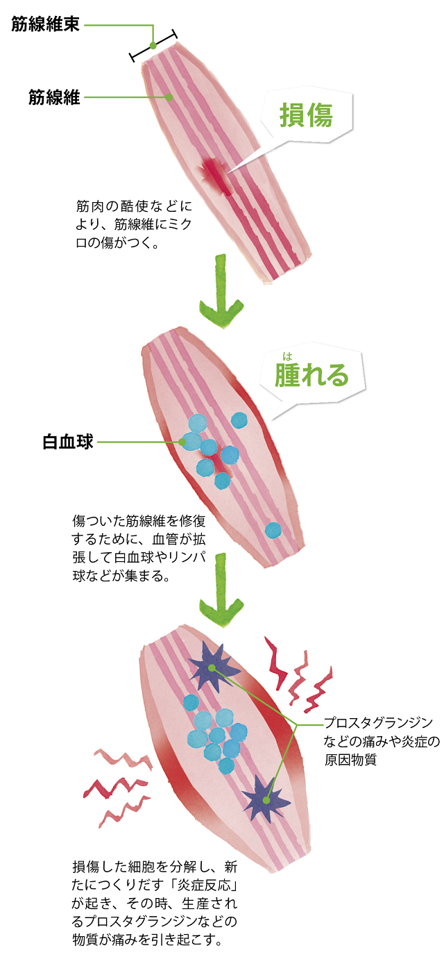 筋を痛めた時の治し方｜冷やす温めるの正解と悪化を防ぐ初期対応