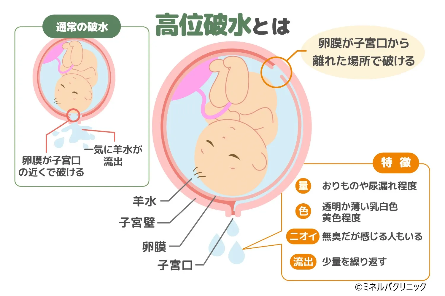 破水とは？尿漏れとの見分け方と絶対にやってはいけないNg行動