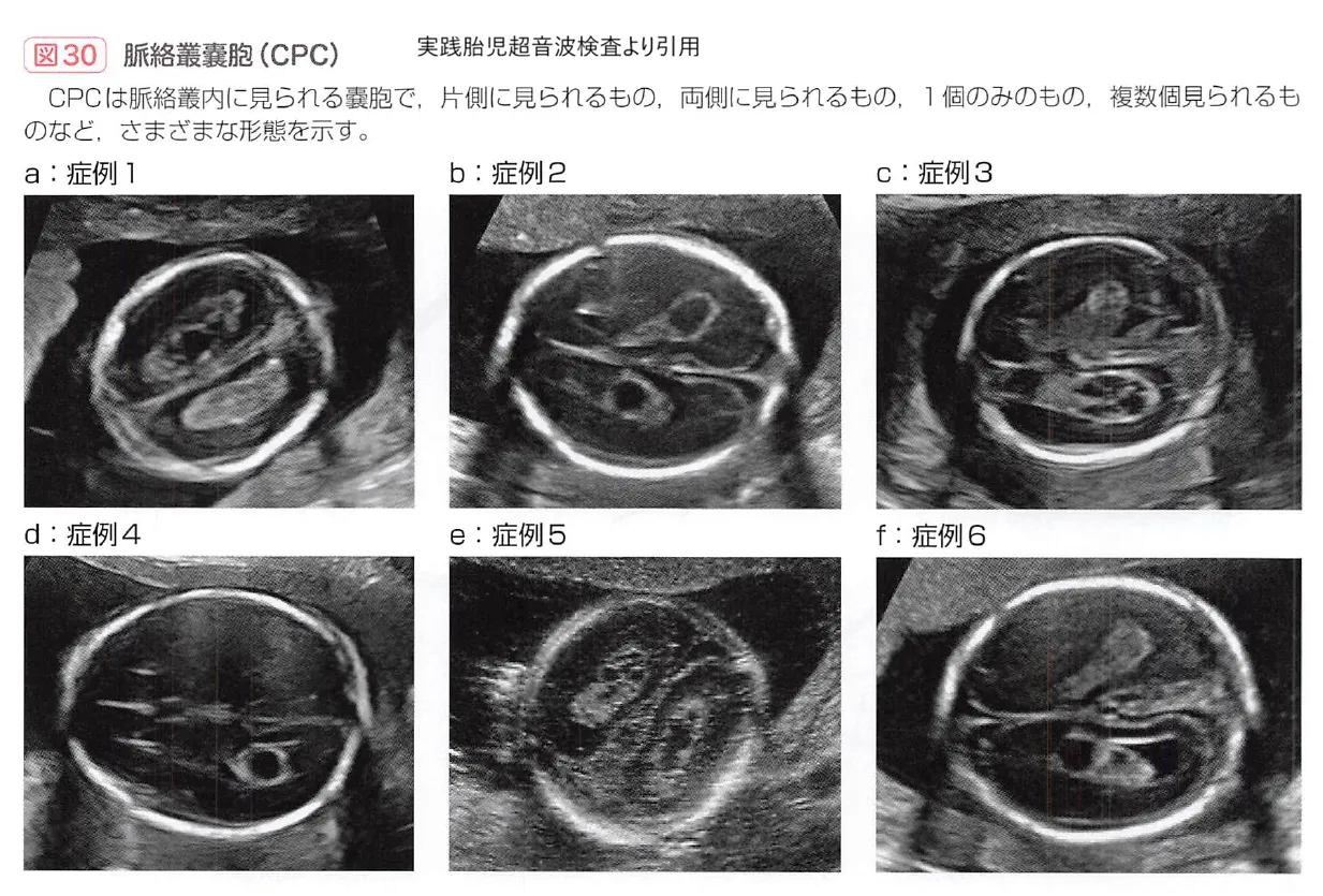 10週エコーでダウン症の特徴はわかる？首のむくみと鼻骨の真相