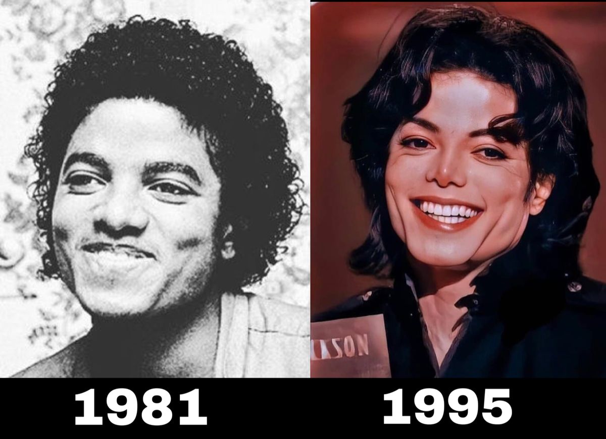 What Did Michael Jackson Do to His Skin