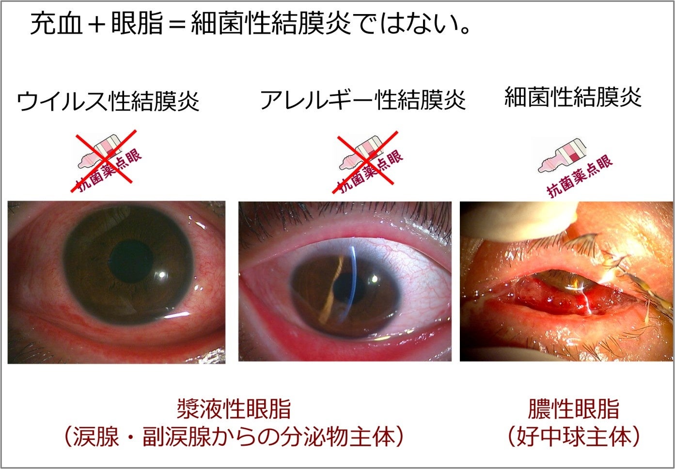結膜炎の細菌性とウイルス性の見分け方｜黄色い目やに放置が危険な訳
