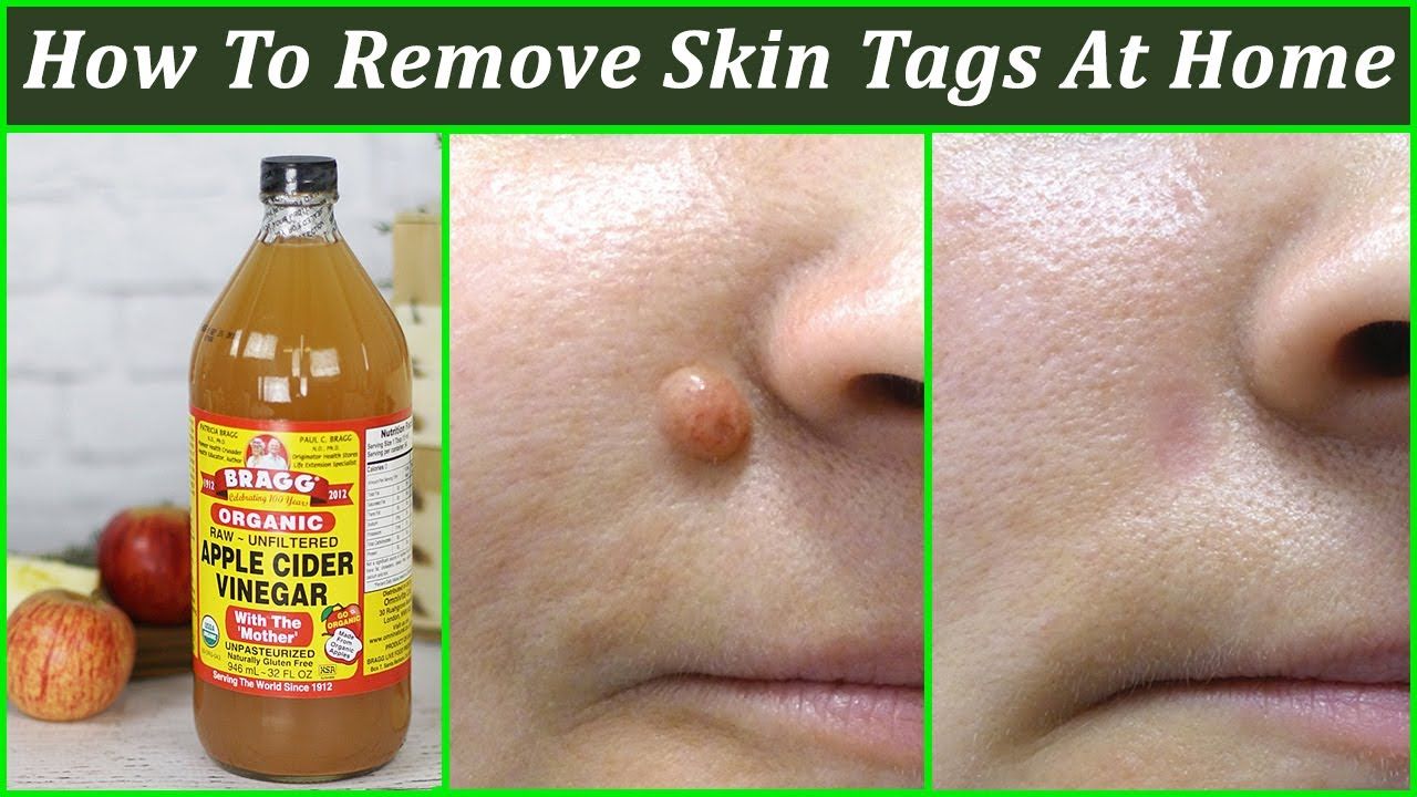 How to Remove Skin Tags with Apple Cider Vinegar