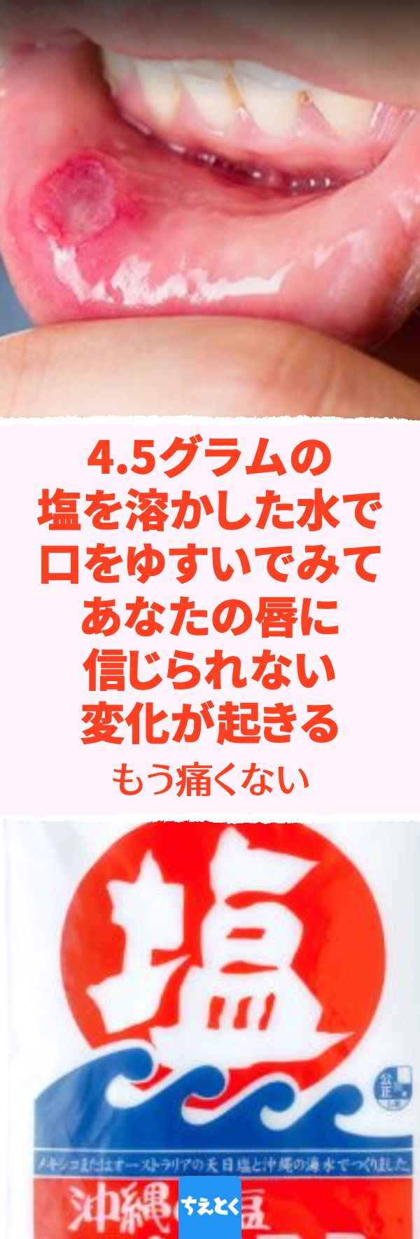 口内炎に塩は危険？即効性ある治し方の真相と正しい塩水うがい