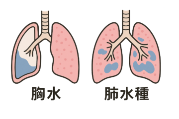 【熱愛】 ベイプ 肺 に 水 が たまる 衝撃の最新ニュース #920