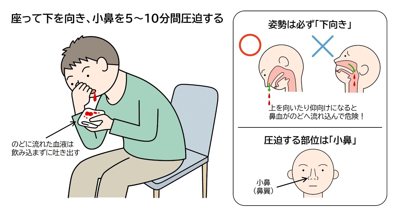 大人が片方だけの鼻血を繰り返す原因とは？危険な病気の兆候と受診目安