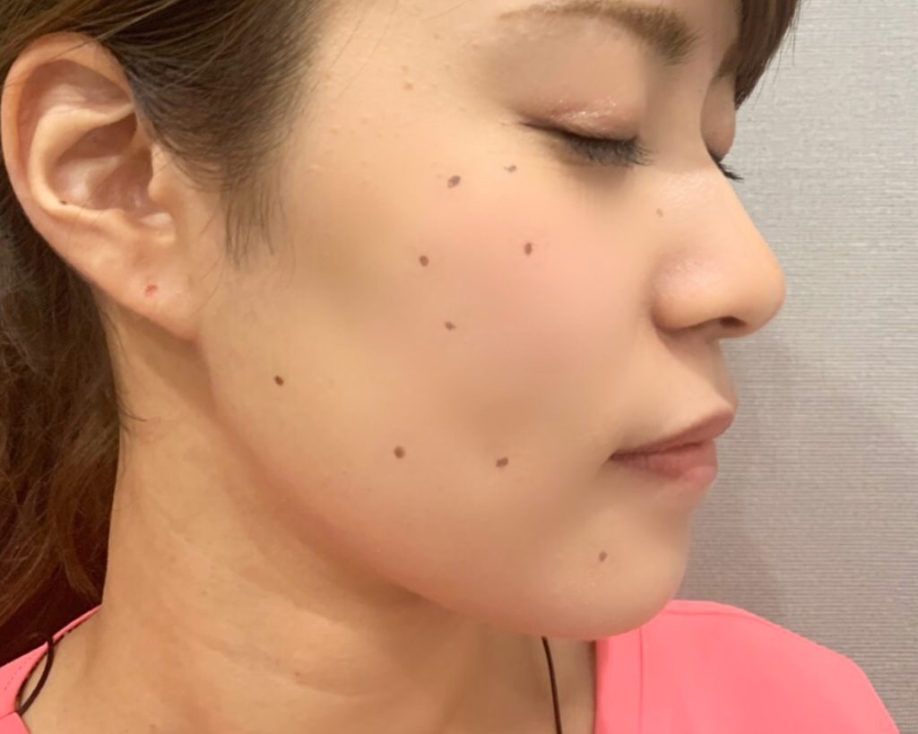 顔の印象が激変？芸能人がほくろを除去した本当の理由と最新施術
