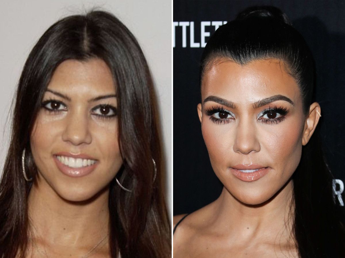 Kardashians Before and After Plastic Surgery