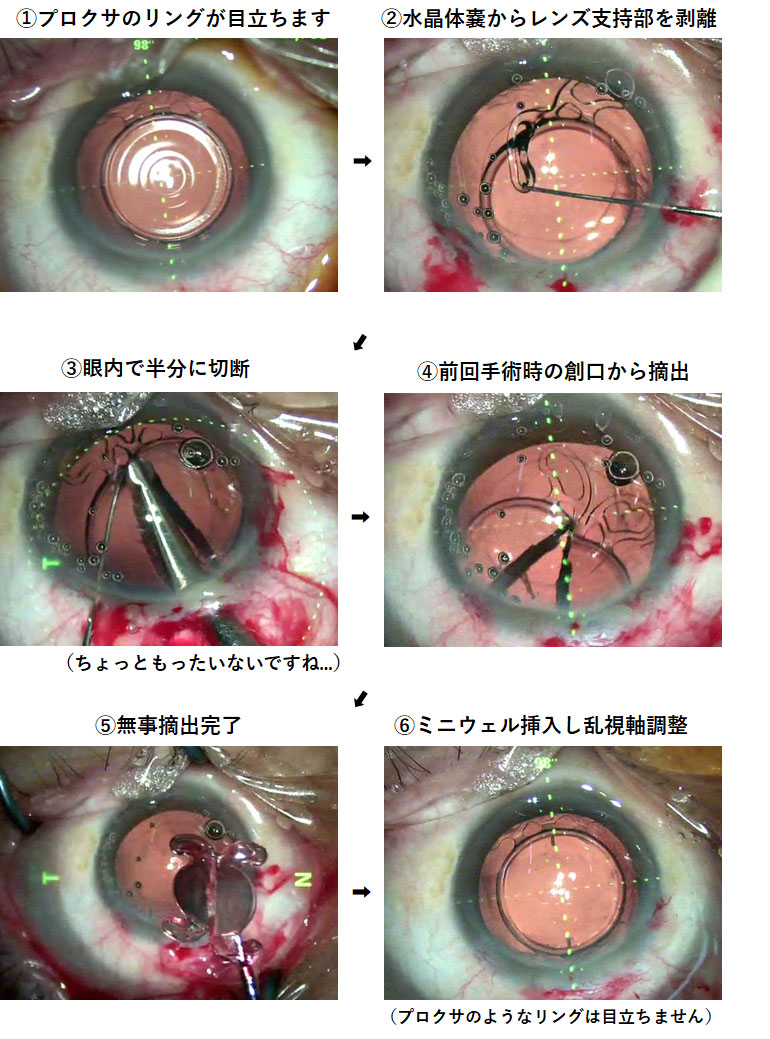 白内障手術後の見え方体験談！青く見える・まぶしい真相と後悔の防ぎ方