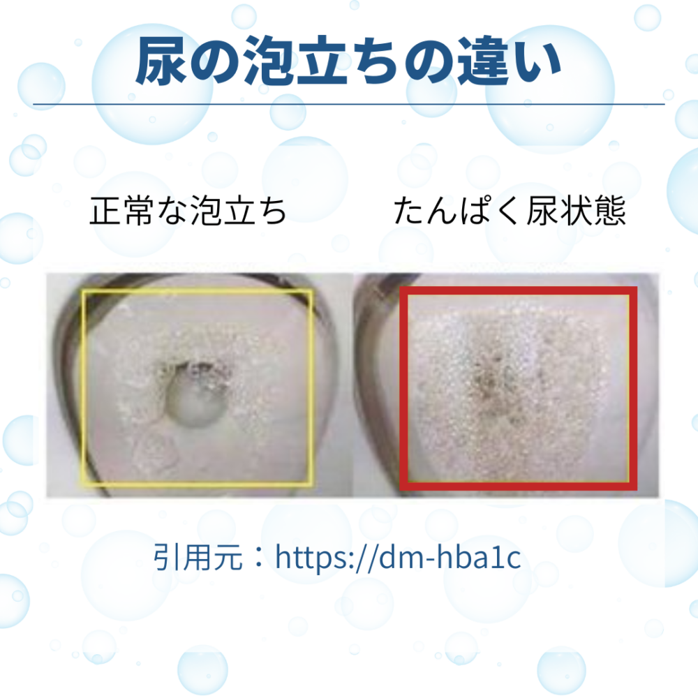 おしっこが泡立つのは病気のサイン？消えない泡の原因と受診目安を解説