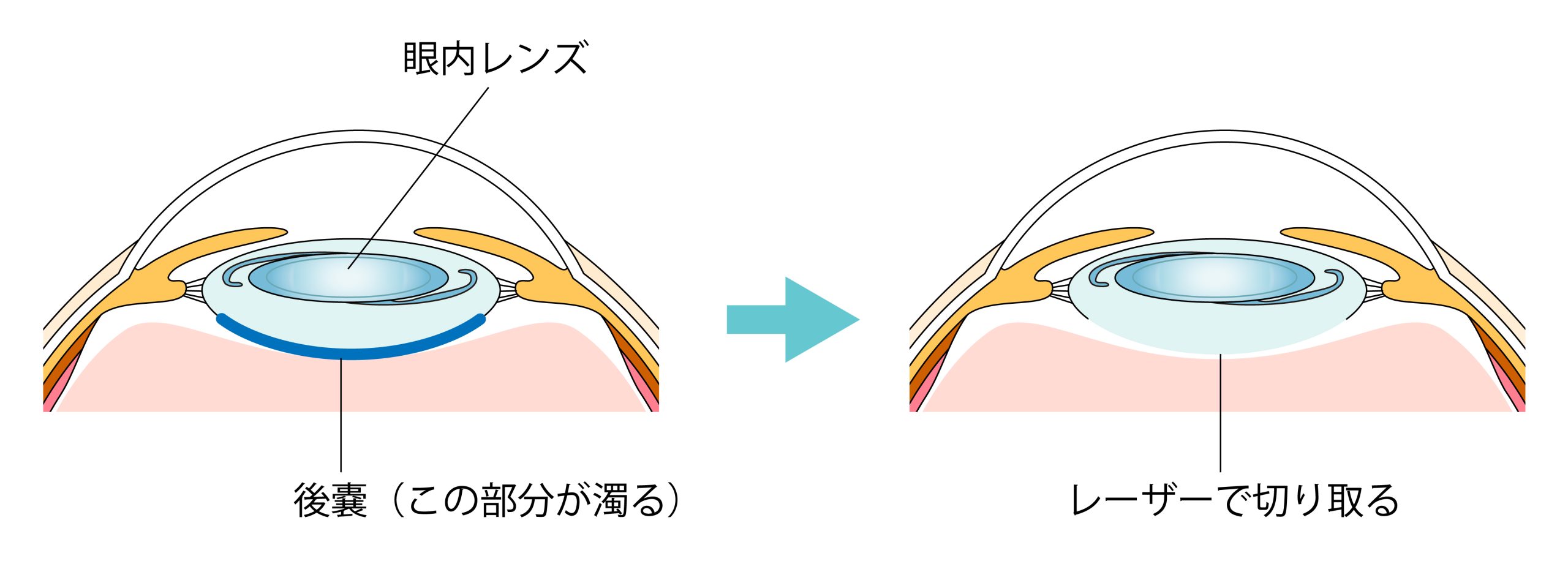 後発白内障の真実｜手術後の視界不良と最新レーザー治療の全貌