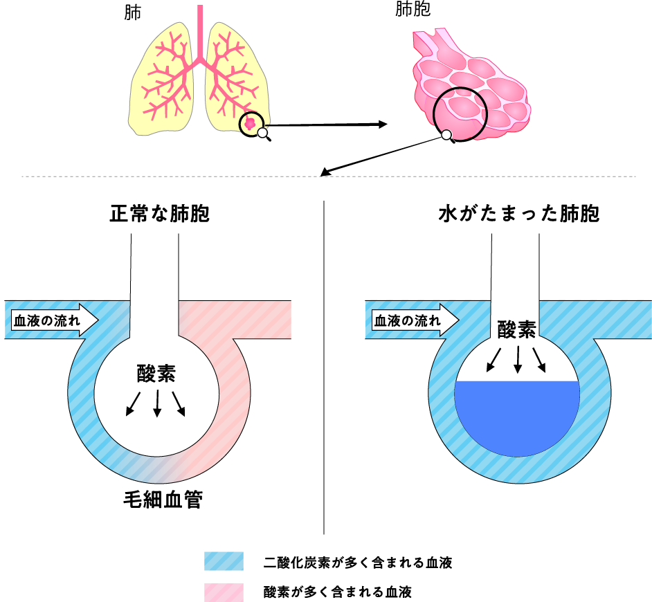 突然の呼吸困難は命の危機？肺水腫の初期症状・原因と胸水との違いを徹底解説