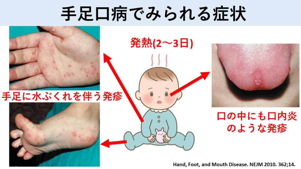 手足口病と水疱瘡の見分け方｜発疹の場所と登園基準の違いを徹底解説