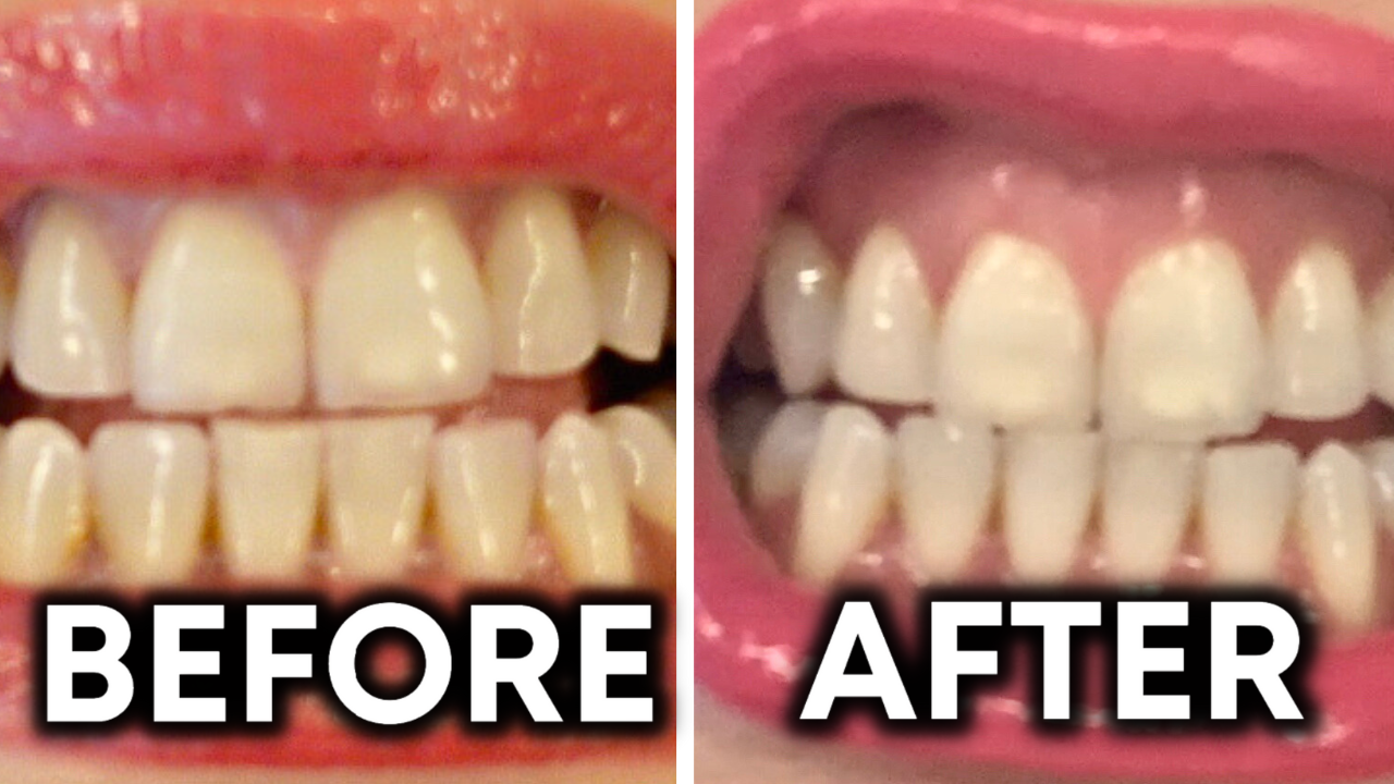Does Peroxide and Baking Soda Whiten Teeth