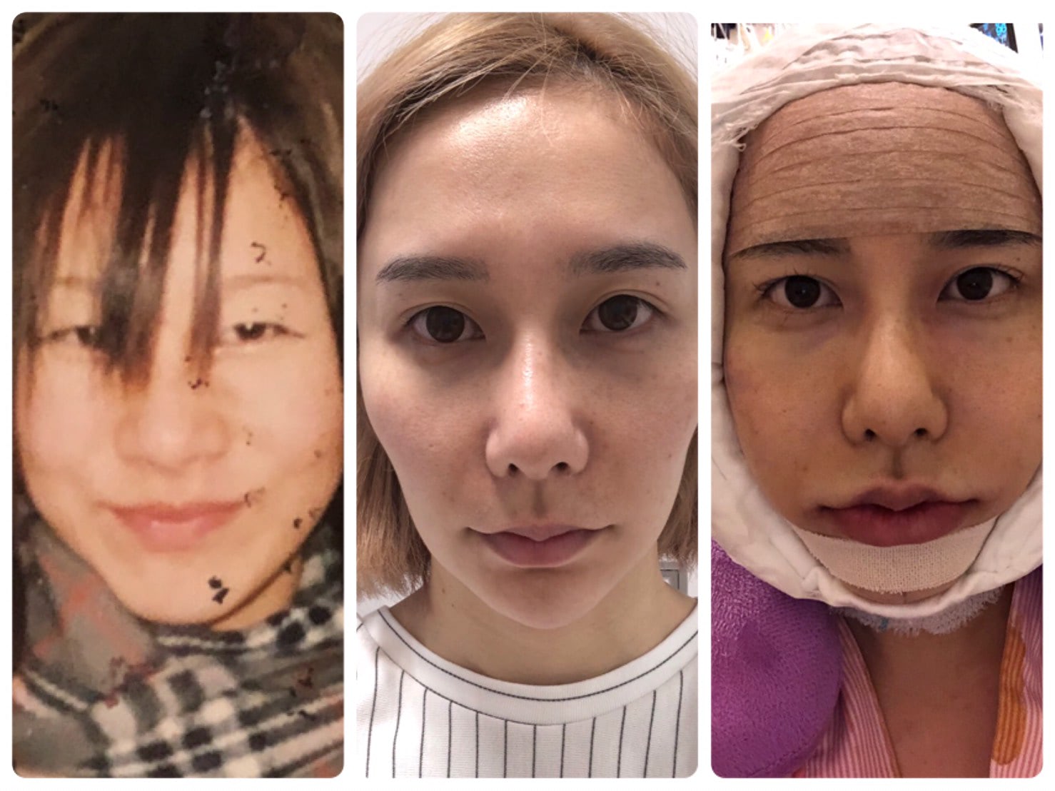 ありしゃん整形総額と施術の全貌！昔の卒アル比較と劇的変化の真実
