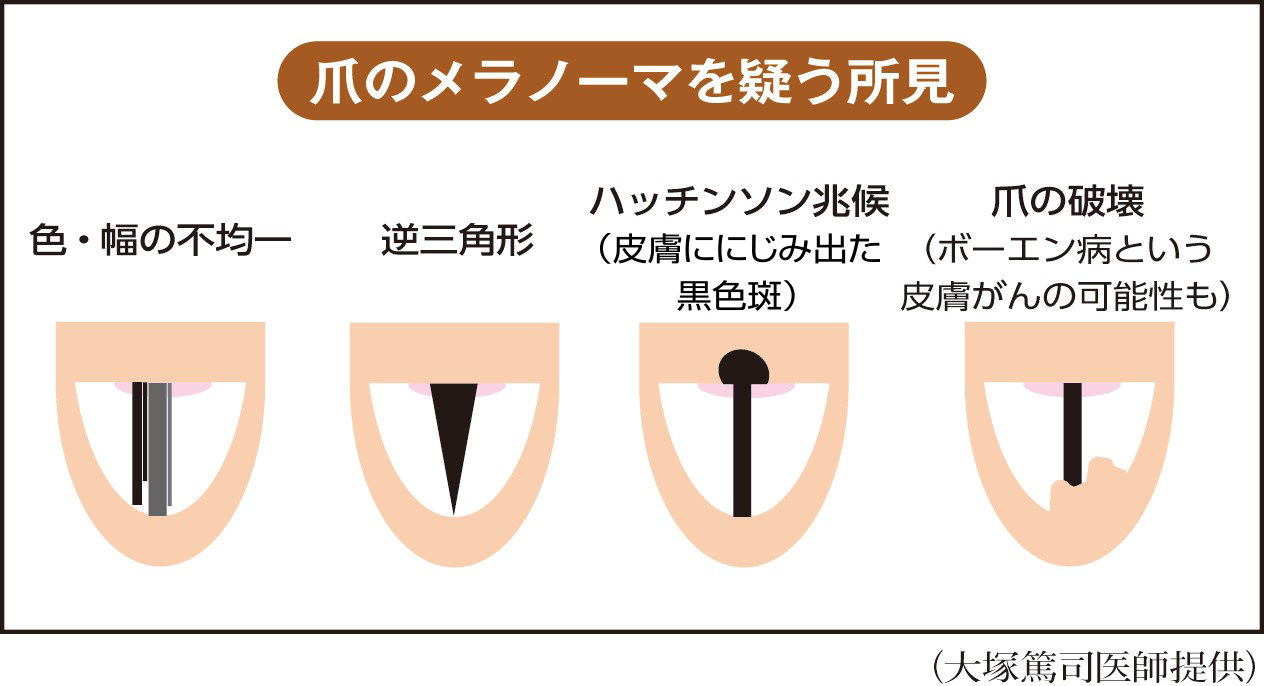 爪の黒い縦線はメラノーマか？危険な見分け方と受診目安を徹底解説