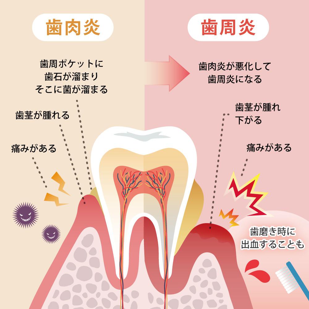 歯石取りで口が血だらけの真相！下手か重度歯周病か原因とNg行動